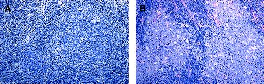 Fig. 2. Structural features of FL 3. / (A) FL 3a. Note that the neoplastic follicular infiltrates are poorly demarcated to the surrounding interfollicular zone and seem to merge with the T-cell area. (B) In contrast, in FL 3b, follicles are sharply demarcated, and there is no merging with the interfollicular infiltrate. Original magnification, × 150. Stained with Giemsa.