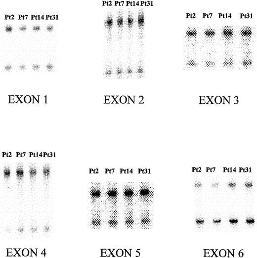 Fig. 1. SSCP profile of exons 1 to 6 of the CBFβgene. / Patient 2 was a healthy subject used as negative control. Patients 7, 14, and 31 had, respectively, M0 AML, M1 AML, and RAEB.