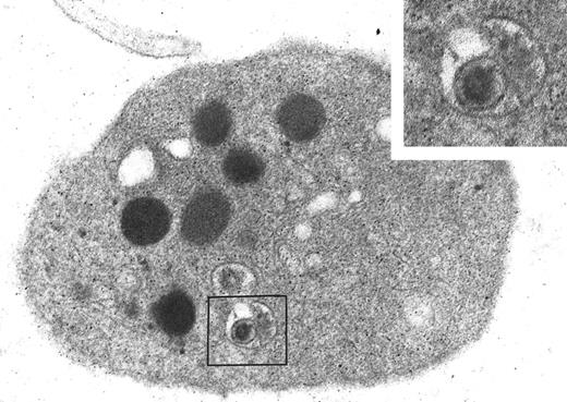 Fig. 6. Ultrastructural study of platelets from a patient with AIDS and thrombocytopenia. / A foreign particle with the size, shape, and dense core characteristic of HIV is detected within an endocytic vacuole in a circulating platelet of this patient. Original magnification, × 48 050; inset original magnification, × 96 100.