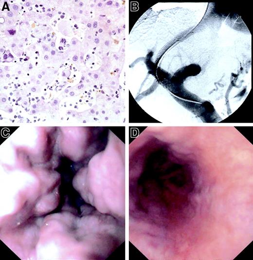 Fig. 1. Histologic, radiologic, and endoscopic presentation. / (A) Extramedullary hematopoiesis in dilated sinuses, hematoxylin-eosin staining. Original magnification × 320. (B) TIPS implantation. (C) Oesophagogastroduodenoscopy before TIPS. (D) Oesophagogastroduodenoscopy after TIPS.