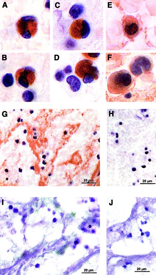 Fig. 2. In situ TF staining of representative human thrombi. / Human arterial or venous thrombi were fixed overnight in 4% paraformaldehyde immediately after thrombectomy and were paraffin-embedded. Five-micrometer sections were deparaffinized and rehydrated, and TF was stained by using digoxigenin-labeled FVIIa (100 nM, 2 h, 37°C) in Tris-buffered saline (TBS) containing 5 mM Ca++, followed by incubation with sheep Fab antidigoxigenin antibody conjugated with horseradish peroxidase (1:1000 dilution, 1 h, 37°C). Color was developed using diaminobenzidine tetrahydrochloride (DAB) (A-D). Immunohistochemical staining was performed on 5-μm sections blocked with 1% peroxyde in methanol and appropriate normal serum and incubated with rabbit polyclonal antihuman TF antibody (1 μg/mL, 2 h, 37°C), stained by a biotin streptavidin–amplified detection system, developed with DAB, and counterstained with hematoxylin (E-G). Another series of nonfixed human arterial or venous thrombi were maintained immediately after thrombectomy in 15% sucrose overnight at 4°C. Then cryosections (8 μm) were blocked with bovine serum albumin (BSA) and incubated with HTF1-7B8, a murine monoclonal anti-TF antibody (20 μg/mL, 1 h, room temperature) followed by a gold-labeled goat antimouse IgG and silver enhancement of the colloidal gold. The sections were embedded in fluorescent mounting medium (I). An irrelevant IgG rabbit mAb was used as a control at equivalent concentration of the specific antibodies (H,J).