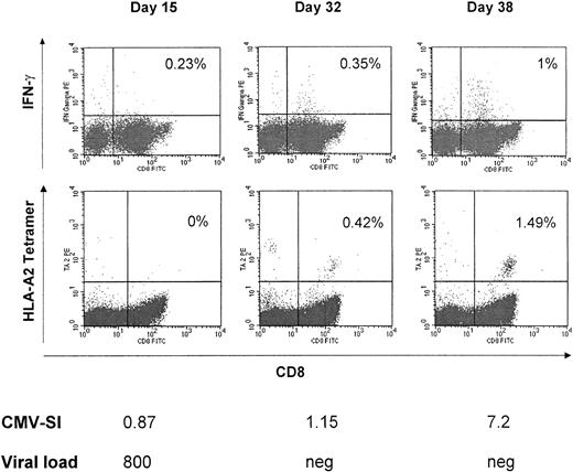 Fig. 4. Reconstitution of CMV-specific T-cell responses and viral load after T-cell transfer. / In patient no. 4, after a high viral load at the time of T-cell transfer, already on day +15 viral load decreased to 800 viral copies/mL blood. At day 38, when the virus had been cleared entirely, reconstitution of CMV-specific lymphoproliferation and CMV peptide-specific A*0201-restricted CD8+ T cells was also shown by intracellular IFN-γ and tetramer staining.