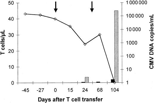 Fig. 5. Virus load and reconstitution of CMV peptide-specific CD8+ and protein-specific CD4+ T cells. / This patient (no. 5) showed only a transient reduction in virus load and a transient occurrence of low numbers of CMV-specific CD4+ and CD8+ T cells 24 days after the first infusion of a CMV-specific T-cell line (1 × 107/m2). After a second T-cell infusion (1 × 107/m2), a rapid reduction of viral load was followed by an increase in the number of circulating CMV-specific CD4+ and CD8+ T cells and a permanent control of CMV infection. Peptide- and protein-specific T cells were analyzed by intracellular IFN-γ staining by flow cytometry after specific stimulation. Virus load was assessed by quantitative PCR (determined as virus copies/mL blood). The line represents the CMV-DNA load in the blood (virus copies/mL blood), the dark bars represent the number of circulating CMV protein-specific CD4+ T cells, and the gray bars represent the number/μL blood of circulating CD8+ T cells specific for the NLVPMVATV CMV peptide, which represents the immunodominant epitope in HLA A*0201-positive individuals. Arrows indicate T-cell infusions.