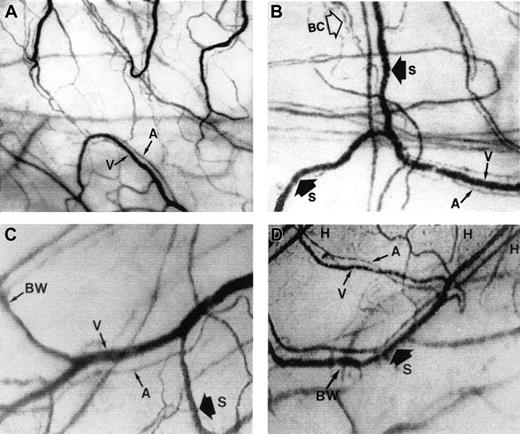 Fig. 1. The microcirculation in the bulbar conjunctiva of the eye. / Optical magnification, × 4.5; onscreen magnification, × 125. A indicates arteriole; V, venule; H, hemosiderin deposit; S, blood sludging; BW, sacculated vessels (beaded or sausage-shaped); and BC, intermittent boxcar blood flow phenomenon. (A) A typical view of the conjunctival microcirculation of a healthy non-SCD subject to serve as reference (35 mm photograph). Note the even and orderly distribution of the normal-sized arterioles and venules and the normal presence of capillaries. (B) The steady-state conjunctival microcirculation of a patient with nonsevere SCD complications (hard copy of a frame-captured image). All the arterioles and venules in the field are wider in diameter than in non-SCD controls. The bulbar conjunctiva of this SCD patient is adequately vascularized; however, vessel distribution is disorganized and uneven, differing from the healthy non-SCD controls. In addition to blood sludging (S), the overall blood flow is sluggish and intermittent as indicated by the presence of the boxcar blood flow phenomenon (BC) in some vessels. The resolution and clarity of this frame-captured image is comparable to a 35 mm photograph (panel A). (C) The steady-state conjunctival microcirculation of another patient with nonsevere SCD complications (frame-captured image). All the vessels in this image are significantly (P < .01) wider in diameter than non-SCD control vessels, and vessel distribution is uneven. Note the unique absence of capillaries and the reduced presence of arterioles and venules in the upper left region of the figure, giving that location a blanched appearance. In addition, sacculated vessels (BW) (beaded or sausage-shaped vessel) and blood sludging (S) are present. (D) The steady-state microcirculation of a patient with severe SCD complications (frame-captured image). Hemosiderin deposits (H) are present, denoting previous extravasation of blood from damaged vessels. The venules are significantly (P < .01) wider in diameter than control vessels. In addition, blood sludging (S) and sacculated vessels (BW) are present.