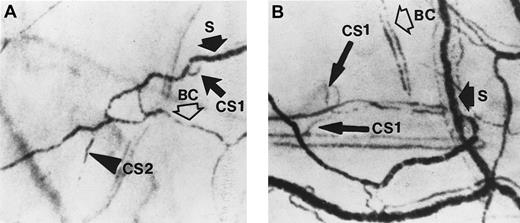 Fig. 2. Two frame-captured steady-state images of the conjunctival microcirculation showing additional microvascular abnormalities. / Optical magnification, × 4.5; onscreen magnification, × 125. (A) Inadequate vascularization (avascularity), two types of comma signs (CS1 and CS2), blood sludging (S), and the intermittent boxcar (sluggish) blood flow phenomenon (BC) are present. (B) Another view of comma signs (CS1), blood sludging (S), and the boxcar blood flow phenomenon (BC).