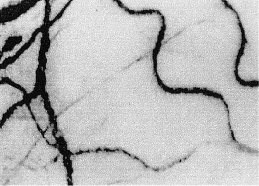Fig. 3. A typical view of the conjunctival microcirculation in an SCD patient 1 hour after hospitalization for painful crisis. / Optical magnification, × 4.5; onscreen magnification, × 125. Characteristic landmark features include extreme conjunctival avascularity, complete absence of capillaries, and a further decrease in the presence of arterioles and small venules, giving the bulbar conjunctival surface a more debilitating vascular presentation than the already avascular steady-state blanched appearance. Note the sustained and significant decrease in venular diameter, increased blood sludging caused by the stoppage of blood flow, a sustained and uniform vasocontraction, and the absence of focal occlusion or constriction in the vessels.