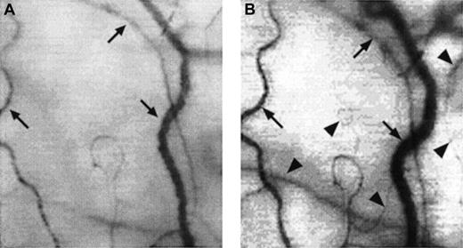 Fig. 4. Two frame-captured images showing microvascular changes during crisis resolution in the same SCD patient. / Optical magnification, × 4.5; onscreen magnification, × 125. Focusing was aimed at the same location during crisis and crisis resolution, with the same vessel serving as its own reference baseline. (A) During crisis, there is significant reduction in vessel diameter and disappearance of capillaries and arterioles, resulting in extreme avascularity. The arrows point at the three vessels targeted for longitudinal comparison during crisis resolution. (B) An increase in vessel diameter and reappearance of capillaries and arterioles occur during crisis resolution. The vessels indicated by the arrows show a significant increase in vessel diameter. In addition, capillaries and arterioles (arrowheads) reappear during crisis resolution.