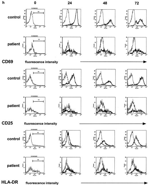 Fig. 2. The induction of cell-surface activation molecules in T-helper cells upon nonspecific stimulation is reduced in the post–T-cell depletion period. / PBMCs were stimulated with immobilized anti-CD3 as described. At the indicated time points, T-helper cells of control samples and patient samples were identified by staining with anti-CD4 and gated; the density of expression of CD69 and of CD25 and of HLA-DR in unstimulated cultures (thin line) and stimulated cultures (thick line) was estimated by the mpc in histogram plots. Patient samples were obtained from a 12-year-old girl with Ewing sarcoma (patient 10) 1 month after completion of conventional high-dose chemotherapy.