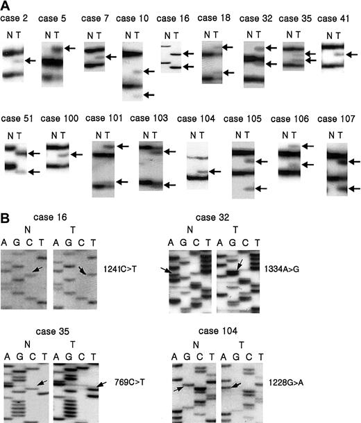 Fig. 1. Mutations and deletions of. / CASP10 gene in NHL. SSCP (A) and sequencing analysis (B) of caspase 10 DNA from tumors (lane T) and normal tissues (lane N). (A) Arrows (lane T) indicate aberrant bands compared to SSCP from normal tissue (N). (B) Arrows indicate nucleotide substitutions in tumor tissue compared to normal tissue.