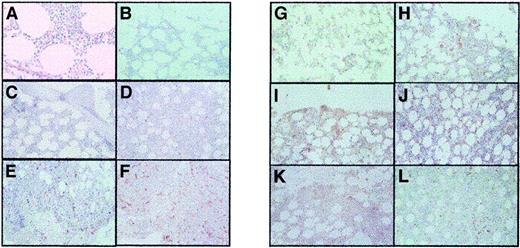 Fig. 1. Bone marrow trephine specimens showing angiogenesis (CD34 staining) and megakaryocyte c-Mpl grading. / The panels show the following: (A) Microvessel grade 1 (MVG 1) (normal); (B) MVG 1 (RT); (C) MVG 1 (ET); (D) MVG 2 (ET); (E) MVG 3 (ET); (F) MVG 4 (ET); (G) c-Mpl 1 (normal); (H) c-Mpl 1 (RT); (I) c-Mpl 1 (ET); (J) c-Mpl 2 (ET); (K) c-Mpl 3 (ET); and (L) c-Mpl 4 (ET). All images were obtained using light microscopy at × 200 magnification.