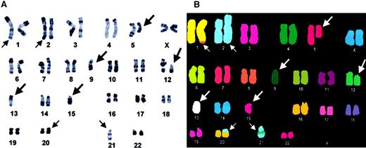 Fig. 1. Karyotype analysis in CD4+, CD56+ DC2 acute leukemia patient UPN3. / Representative R-banded (A) and M-FISH-Metasystems probe (B) karyotypes. Arrows indicate the presence of chromosomal abnormalities; large arrows identify recurrent anomalies in DC2 acute leukemia; small arrows identify other chromosomal changes. Modal number is 42. M-FISH allows to interpret add(1)(q41) as a der(1)t(1;8), add(2) as a dup(2), der(20) as a der(20)t(20;21), and add(21)(q22) as a der(21)(21p13 → 21q22::12::21q11→21qter). M-FISH also confirms the complete loss of chromosomes 9, 13, and 15 as well as partial 5q13q33 monosomy.