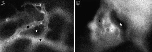 Fig. 1. Representative micrographs of 150-kd FITC-dextran distribution in skull BM of a nonirradiated mouse and an animal 48 hours after irradiation. / (A) In normal BM, the high–molecular-weight plasma marker stays confined to the lumen of BM venules and sinusoids (*). There is no extravasation into extravascular BM cavities (+). (B) Irradiation-induced damage to BM endothelium causes a massive breakdown of endothelial barrier function, leading to the extravasation of FITC-dextran into BM cavities but not into adjacent solid bone tissue. Because of quenching of fluorescence by hemoglobin-rich erythrocytes, larger microvessels now appear darker than the surrounding extravascular compartment. Recordings in both animals were taken under identical conditions using a × 40 objective.