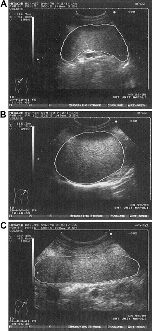 Fig. 2. Various spleen shapes detected by US. / (A) Spleen in a control subject having normal longitudinal diameter and volume. (B) Spleen in a thrombocythemic patient having longitudinal diameter like that in Figure 2A but clearly enlarged volume. (C) Spleen in a control subject showing enlarged longitudinal diameter but normal volume (rodlike spleen).