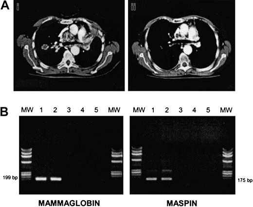 Fig. 1. Responses to allografting in renal cell cancer and breast cancer. / (A) CT thorax scan of patient no. 7 before (i) and after (ii) DLI plus IFNα. (B) RT-PCR analysis of mammaglobin and maspin expression in bone marrow cells of patient no. 6 before and after DLI. Bone marrow mononuclear cells were analyzed for mammaglobin and maspin expression preallograft (lane 1), before DLI (lane 2), and after DLI (lane 3), respectively. Lane 4: negative control; lane 5: no DNA. MW indicates molecular weight marker.