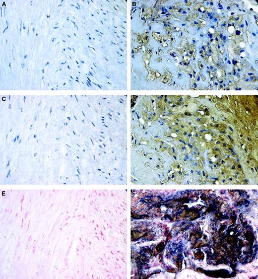 Fig. 5. Patterns of localization of fVIII and oxLDL in atherosclerotic lesions. / Human coronary atherectomy sections containing normal media (A,C,E) and atheromatous regions (B,D,F) were stained for oxLDL (A,B) or fVIII (C,D) using mAbs OXL41.1 and ESH8, respectively, and double stained for both components (E,F). The single and double staining were performed as described in “Materials and methods.” Positive staining for oxLDL and fVIII in panels B and D is brown; cell nuclei in panels A through D are counterstained with hematoxylin. In double-stained images, panels E and F, accumulations of fVIII (blue) and oxLDL (brown) frequently overlap as evidenced by presence of areas stained black. Cell nuclei in panels E and F were counterstained with nuclear fast red. Microscopy was performed using an Eclipse E800 microscope at magnification × 600.