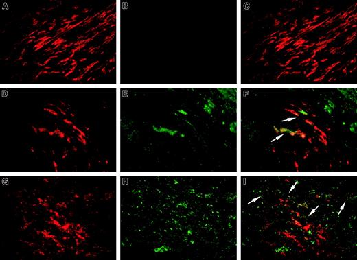 Fig. 6. Detection of fVIII, macrophages, and SMCs in atherosclerotic lesions. / Sections of a human coronary atherectomy specimen containing normal media (A-C) and atheromatous regions (D-I) were double stained for fVIII (B,E,H, green fluorescence) and α-actin (A,D,red fluorescence) or CD68 (G, red fluorescence) as specific markers for SMCs and macrophages, respectively. Staining procedure is described in “Materials and methods. The single-stained images were obtained in an Eclipse E800 microscope at magnification × 1000 using selective fluorescent filter blocks. The merged images (C,F,I) were obtained by superimposing single-stained images using SPOT Advance Program Mode. Arrows in panels F and I point to fVIII staining (green fluorescence) on the periphery of selected SMCs and macrophages, respectively (red fluorescence). The staining patterns similar to those presented in this figure were found in all specimens analyzed.