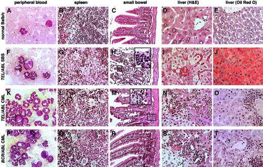 Fig. 5. Comparative histopathological findings in TEL-ABL–induced andBCR-ABL–induced hematologic diseases. / Photomicrographs of Wright-Giemsa–stained PB (panels A, F, K, and P); hematoxylin-eosin–stained spleen (panels B, G, L, and Q), small bowel (panels C, H, M, and R), and hematoxylin-eosin–stained liver (panels D, I, N, and S); and ORO-stained liver (panels E, J, O, and T) from mice with TEL-ABL–induced SBS (panels F-J),TEL-ABL–induced CML-like disease (panels K-O), andBCR-ABL–induced CML-like disease (panels P-T). A Balb/c mouse killed 5 weeks after transplantation with untransduced bone marrow was used as the control (panels A-E). Magnifications are ×750 for PB, ×100 for small bowel, and ×200 for liver and spleen. Although mice with TEL-ABL–induced CML-like disease occasionally had infiltration of the bowel submucosa with neutrophils (panel M, ×500 insert), neutrophil infiltration of villi was found only in mice with SBS (panel H, ×500 insert).