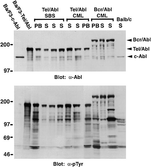 Fig. 6. Myeloid cells from mice with SBS and CML-like leukemia express Tel-Abl protein. / Protein lysates from PB leukocytes and spleen cells (S) from mice withTEL-ABL–induced SBS, TEL-ABL–induced CML-like disease, and p210 BCR-ABL–induced CML-like disease were analyzed by Western blotting with anti-Abl (top panel) and antiphosphotyrosine (bottom panel) antibodies. Extracts from splenocytes from a normal Balb/c mouse (Balb/c) and from Ba-F3 cells expressing c-Abl or Tel-Abl were included as controls. The figure shows a composite of 2 blotting studies done simultaneously under identical conditions.