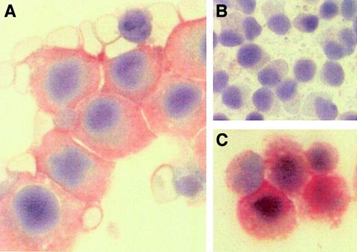 Fig. 1. Immunocytochemistry of bone marrow myeloma cells and controls. / (A) RANKL immunostaining shows strong positivity in myeloma cells obtained by bone marrow aspirate from a patient with multiple myeloma and osteolytic lesions. (B) Negative control staining using an irrelevant antibody (pancytokeratin). (C) SaOs-2 cells, a human osteosarcoma cell line, which is known to express RANKL, served as a positive control.