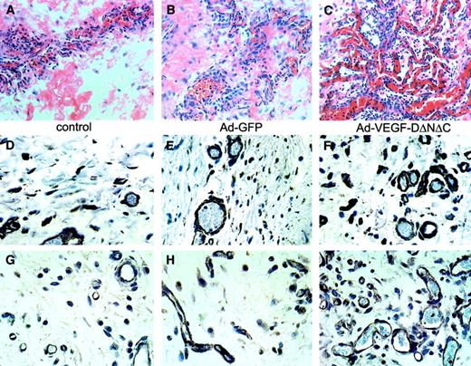 Fig. 5. Vasculature induced by Ad-VEGF-DΔNΔC in skin. / Focal areas of hypodermis taken from rat 1 week after subdermal injection with PBS (A, D, G), Ad-GFP (B, E, H), or Ad-VEGF-DΔNΔC (C, F, I). Hematoxylin and eosin–stained tissue sections are shown (A-C); ×20 objective. (A) Small tuft of vessels primarily composed of veins with surrounding monocytes, lymphocytes, and macrophages. (B) Irregular, small veins with some signs of inflammation. (C) Venous channels with extremely irregular branching, consistent with an area of vascular proliferation. Tissue sections were stained for laminin (D-F) or VEGFR-2 (G-I). Dramatic increase in the density of laminin and VEGFR-2–positive blood vessels as a result of Ad-VEGF-DΔNΔC injection is evident. Panels D-I, ×40 objective.