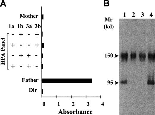 Fig. 1. Identification and characterization of the anti-Duva+ antibody by the techniques of MAIPA and Western blot. / (A) The reactivity of the serum Duv was tested in MAIPA with the mother's platelets, 4 panel platelets, and the father's platelets by using the Moab Pl1-64 to capture the GP IIb-IIIa complex. Paternal autoantibodies were searched for by direct incubation of the platelets with the Moabs (Dir). (B) Immunoblot of SDS-soluble platelet proteins subjected to SDS–polyacrylamide gel electrophoresis under nonreduced conditions and transferred to nitrocellulose membrane. The maternal serum Duv was tested with father's platelets (lane 1), mother's platelets (lane 2), and a control donor (lane 3). An anti–HPA-1a serum (anti–GP IIIa) was used as positive control (lane 4). Human IgGs were revealed by using an antihuman IgG conjugated to the peroxidase associated to the chemiluminescence detection technique. The maternal serum Duv bound specifically to a protein migrating in the position of GP IIIa of the father's platelets.