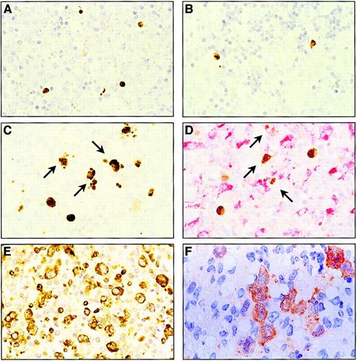 Fig. 1. Detection of active caspase 3, PARP-1/p89, Bcl-2, and PI9 in tumor cells of systemic ALCL. / (A) Biopsy specimen of an ALCL patient with more than 5% active caspase 3–positive tumor cells (brown nuclear staining). (B) Biopsy specimen of the same ALCL patient with more than 5% PARP-1/p89–positive tumor cells (brown nuclear staining). Original magnification for panels A and B is × 200. (C) Biopsy specimen of an ALCL patient with more than 5% active caspase 3–positive tumor cells (brown nuclear staining) in combination with cytoplasmic staining of nuclear debris in cells with a macrophagelike morphology (arrows). (D) Double staining of active caspase 3 (brown) and CD68 (red) in a case of ALCL showing cytoplasmic staining of active caspase 3–positive debris. Apart from 2 CD68-negative cells with large, active caspase 3–positive nuclei, 3 CD68–positive cells are observed with active caspase 3–positive cytoplasmic debris (arrows). (E) Biopsy specimen of an ALCL patient with 50% or more Bcl-2–positive tumor cells (brown cytoplasmic staining). Reactive lymphocytes serve as an internal positive control. (F) Red cytoplasmic staining of PI9 in tumor cells of an ALCL case, with dendritic cells serving as an internal positive control. Original magnification for panels C-F is × 400.