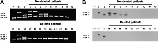 Fig. 2. Detection of the ABL-BCR transcript by RT-PCR and Southern blotting. / Ethidium bromide–stained agarose gels (panel A) and Southern blots (panel B) from the same patients were run on different gels. Lanes 4-11 show nondeleted patients; lanes 16-23, deleted patients. Lanes 1 and 13 show HL6O (BCR-ABL–negative) cell line; lanes 2 and 14, Meg-1 cell line; lanes 3 and 15, LAMA cell line, lanes 12 and 24, water control. 1b-b3 indicatesABL1b-BCRb3 transcript; 1b-b4,ABL1b-BCRb4 transcript; PBGD, porphobilinogen deaminase transcript.