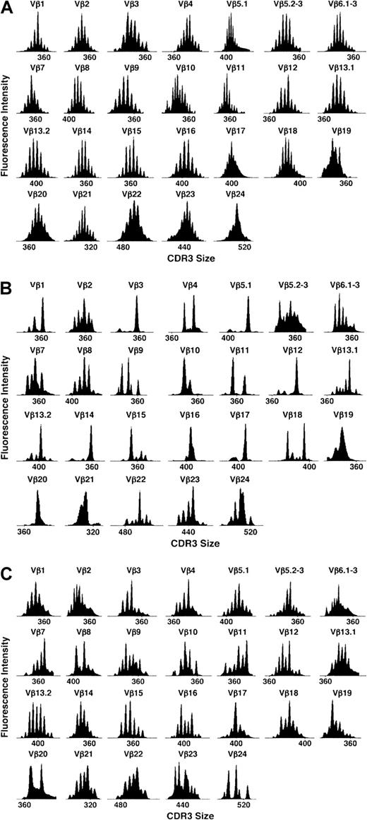 Fig. 2. Representative examples of TCR Vβ repertoire profiles. / Profiles are in a healthy donor (A), patient no. 6 at 3 months after BMT (B), and the same patient 3 months after DLI (C).