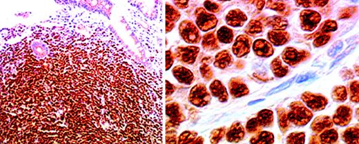 Fig. 1. Cyclin D1 immunostaining of neoplastic cell nuclei in a case of lymphomatoid polyposis, shown at low power (left) and high power (right). / An immunoperoxidase technique in a paraffin section was used. Original magnification left, × 100; right, × 800.