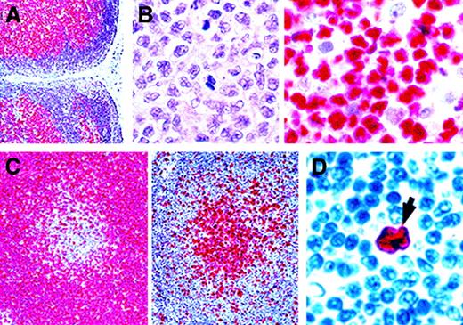 Fig. 3. BCL-6 immunostaining of normal and neoplastic lymphoid cells. / (A) BCL-6 expression in germinal centers in a lymph node showing follicular hyperplasia. (B) Diffuse large B-cell lymphoma. At left is a section stained with hematoxylin and eosin, and at right is a sample with BCL-6 immunostaining showing strong nuclear expression. (C) A trapped germinal center in a mantle lymphoma is BCL-2 negative (left) and BCL-6 positive (right). (D) BCL-6 expression by a popcorn/L&H cell (arrow) in nodular lymphocyte predominance HD (APAAP technique in paraffin sections; reproduced with permission from American Journal of Pathology106). Original magnification A, × 100; B left, × 800; B right, × 800; C left, × 200; C right, × 200; D, × 800.