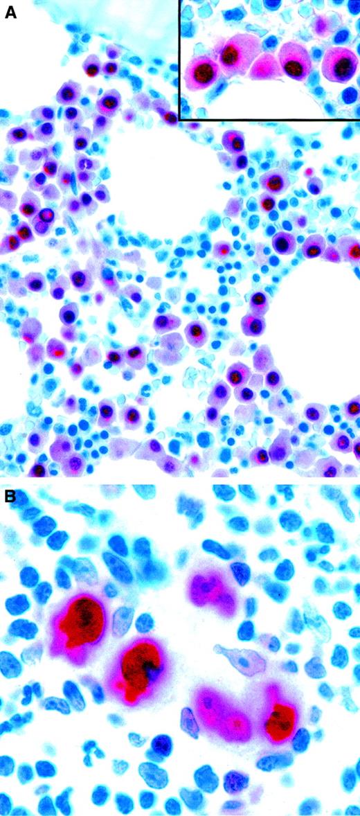 Fig. 4. Expression of the plasma cell–associated marker MUM1/IRF4 in neoplastic lymphoid cells. / (A) Bone marrow biopsy specimen showing infiltration by multiple myeloma. Monoclonal MUM1/IRF4 is present in the nuclei and the perinuclear area in neoplastic plasma cells. Residual hemopoietic elements are unlabeled. The inset shows higher magnification-view of the same field. (B) Strong labeling of tumor cells in classic HD (APAAP technique in paraffin sections). Original magnification A, × 600; A inset, × 1000; B, × 1000.