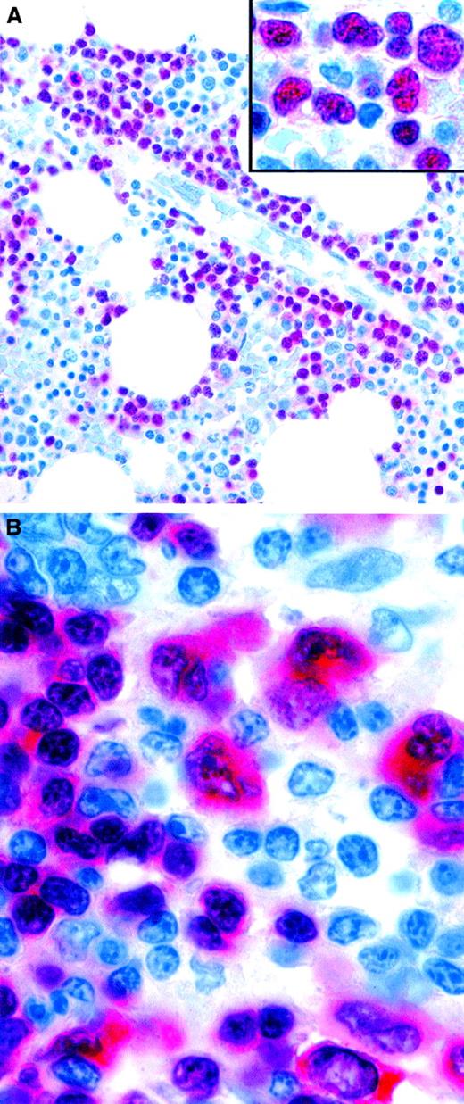Fig. 5. Expression of the PAX-5 (BSAP) transcription factor in neoplastic lymphoid cells. / (A) Pro-B acute lymphoblastic leukemia cells in a bone marrow biopsy specimen are selectively stained. The inset is a higher magnification, showing the irregular nuclei of PAX-5–positive leukemic cells. (B) Tumor cells of classic HD showing nuclear labeling, as well as cytoplasmic staining. Normal residual mantle zone B cells also express PAX-5 (APAAP technique in paraffin sections). Original magnification A, × 400; A inset, × 800; B, × 1000.