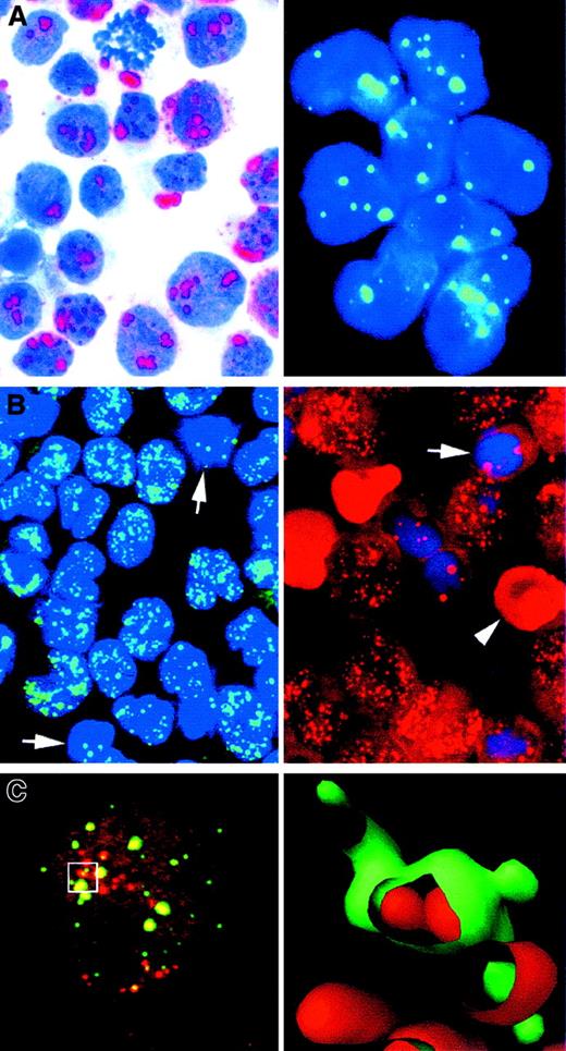 Fig. 7. Staining for wild-type and hybrid PML proteins. / (A) Speckled nuclear staining, representing wild-type PML, in transfected U937 cells (left) and in a case of FAB-M5 acute leukemia (right). (B) Nuclear microspeckled staining pattern indicating the presence of hybrid PML-RARα protein in 2 cases of APL. Single arrows indicate normal residual marrow cells; and arrowhead, a red blood cell (APAAP and immunofluorescent techniques in cytospin preparations; reproduced with permission from Blood177). (C) Laser-scan confocal microscopy of the KG1 myeloid cell line double stained for PML (green) and PLZF (red). At left is the confocal image. At right is a 3-dimensional reconstruction of the area outlined on the left panel, showing the spatial relation between PML and PLZF in the nuclear bodies. Original magnification A-C, × 1000.
