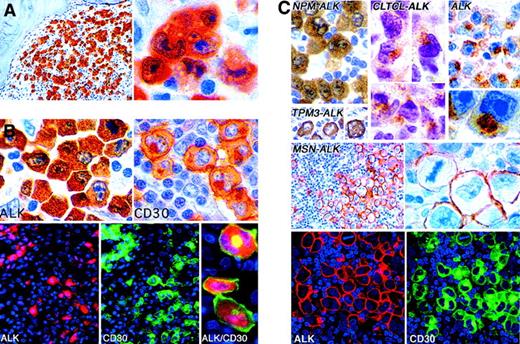 Fig. 8. Immunostaining of lymphomas for ALK proteins. / (A) Labeling for NPM-ALK in the nucleus and cytoplasm in a lymphoma with anaplastic large cell morphologic characteristics. (B) A t(2;5)-positive large cell lymphoma showing the contrast between NPM-ALK expression (cytoplasmic with some nuclear staining) and CD30 staining (surface membrane and Golgi-associated labeling). The double fluorescent images at bottom show that the same cells express CD30 and ALK but in different patterns. (C) Different patterns of ALK immunostaining in lymphomas. All tumors contain a hybrid ALK protein, except for that marked ALK, an example of the rare subtype of large B-cell lymphoma (CD30-negative and positive for epithelial membrane antigen) in which full-length wild-type ALK protein is expressed. (Immunoperoxidase and immunofluorescence techniques in paraffin sections; reproduced with permission from Blood227258 and Laboratory Investigation212.) Original magnification A left, × 250; A right, × 1000; B top, × 1000; B bottom (ALK and CD30, × 400; ALK/CD30, × 1000); C, × 400 to × 1000.