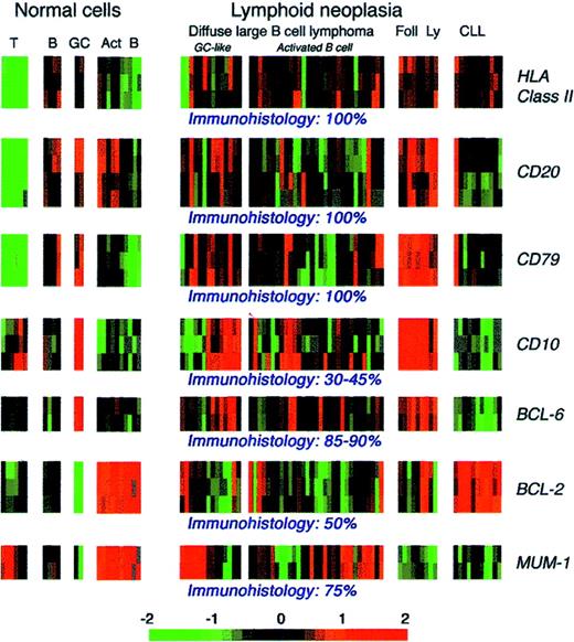Fig. 9. Microarray patterns of mRNA expression for 7 lymphoid-associated genes in normal and neoplastic lymphoid cells. / These data are from a series reported by Alizadeh et al (http://llmpp.nih.gov/lymphoma) that included samples of diffuse large B-cell lymphomas. On the basis of microarray analysis, these tumors were assigned to 2 categories (with different clinical behavior), with one resembling germinal-center cells and the other having an activated B-cell phenotype. The frequency of positive immunostaining for the 7 markers in diffuse large B-cell lymphoma indicated by published studies and the authors' experience is indicated beneath the microarray images. Act B indicates activated B cells; B, B cells; CLL, B-cell chronic lymphocytic lymphoma; Foll Ly, follicular lymphoma; GC, germinal-center cells; and T, T cells.