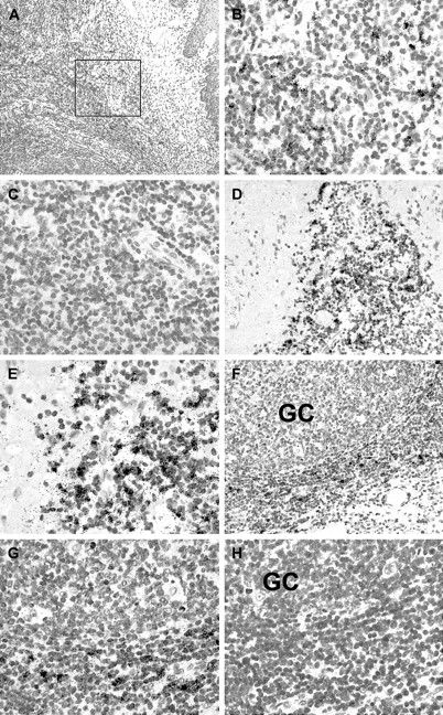 Fig. 2. In situ expression of recombination-activating genes in human tonsil. / In situ hybridization reveals focal clusters of RAG-positive cells in human tonsil sections as indicated by the presence of black silver grains. (A) Low power magnification shows tonsillar epithelium at the right margin of this figure. The boxed area is shown at high power in B and C. (B) Using 35S-labeled RAG-specific antisense probes, several labeled cells are detected in this area, whereas in (C) no specific labeling is seen in the same area using the corresponding sense probes. (D) In a different tonsil, numerous RAG-expressing cells are seen at the boundary between lymphoid tissue and fibrous connective tissue. (E) A higher power view of the same areas as in D. (F) In another tonsil, RAG-positive cells are observed in the vicinity of a germinal center (GC). (G) A high power view of the same area as in F. (H) No specific labeling is seen in the same case using the corresponding sense probes.