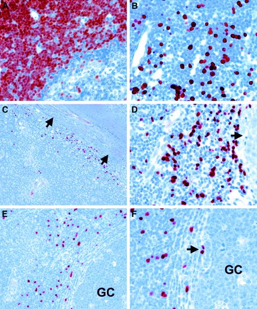 Fig. 3. In situ expression of TdT in human tonsil. / (A) Immunohistochemistry with a TdT-specific antiserum (note red-brown staining) shows strong nuclear labeling of cortical thymocytes in a human thymus. (B) Scattered TdT-positive cells are also detected in bone marrow. (C, D) Immunohistology with a TdT-specific reagent (note red nuclear labeling) reveals numerous TdT-positive cells at the boundary between lymphoid tissue and fibrous scaffold at (C) low and (D) high power (arrows indicate fibrous tissue in C and D). (E, F) In a different case, TdT-positive cells are present in the vicinity of a germinal center (GC) at (E) low power and (F) high power. Note the presence of isolate-labeled cells at the edge of a germinal center in F (arrow).
