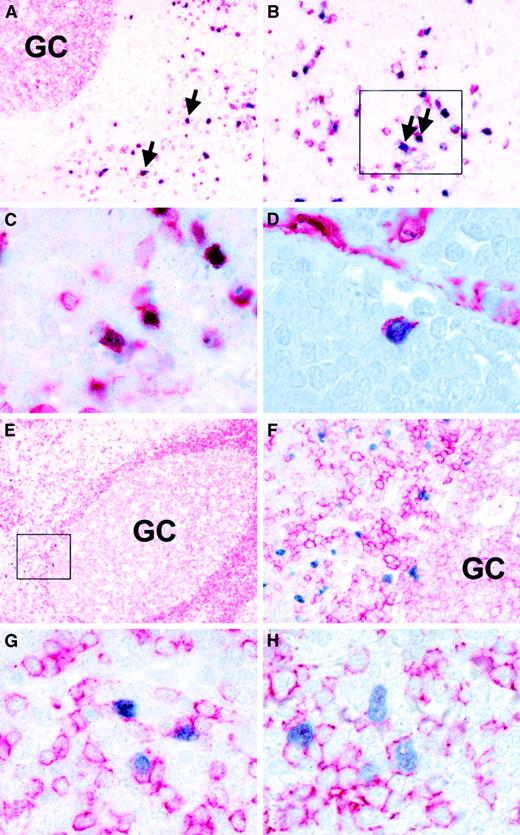 Fig. 4. Phenotypic characterization of TdT-positive cells. / Double-staining immunohistochemistry with a TdT-specific antiserum (blue nuclear labeling) and cell surface markers (red staining) shows (A, B, C) coexpression of TdT and CD10 (arrows). C represents the boxed area in B. (D) Double-labeling reveals coexpression of TdT and CD34 in a single cells. Note reactivity of endothelial cells with the CD34 reagent in the top right hand corner. (E, F) Double-staining with TdT- and CD79a-specific antibodies reveals localization of TdT-positive cells outside a germinal center near the dark zone. F represents the boxed area in E at high power. Note that TdT-positive cells are negative for CD79a in this image. (G) This panel illustrates the presence of a few TdT-positive cells coexpressing CD79a. (H) Double-staining with TdT- and CD20-specific antibodies also reveals isolated TdT-positive cells coexpressing CD20.