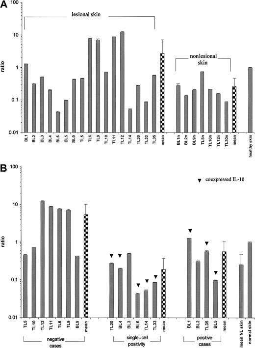 Fig. 2. Relative HLA-G1 transcriptional levels in primary CLs. / Values are expressed as mean ± SD GAPDH-balanced ratios (as a result of triplicate runs) multiplied by 104. (A) Pattern of HLA-G1 expression in lesional (n = 17) versus nonlesional (n = 7) and a control healthy skin. The Student t test was performed; t = 2.54, P = .022. (B) Relative HLA-G1 transcriptional levels grouped according to the immunoreactivity with 4H84 mAb. Levels of HLA-G1 mRNA expression in cases showing no 4H84 immunoreactivity (n = 7) versus single-cell positivity (n = 5) versus HLA-G protein–positive lymphoma cases (n = 4). In some cases HLA-G immunoreactivity coincided with IL-10 expression (▾). NL indicates nonlesional skin.