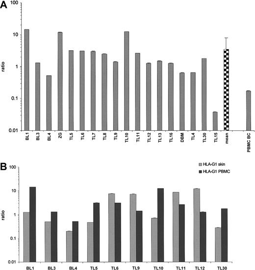 Fig. 3. Relative HLA-G1 mRNA levels in PBMCs obtained from primary CL patients. / (A) Values are expressed as mean ± SD GAPDH-balanced ratios (as a result of triplicate runs) multiplied by 104. BC indicates buffy coat. (B) Relative HLA-G1 transcriptional levels in lesional skin and PBMCs of primary CL patients. Note that 4 patients with CTCL (TL6, TL9, TL11, TL12) exhibited an average 4 times higher HLA-G transcription in lesional skin than in PBMCs.