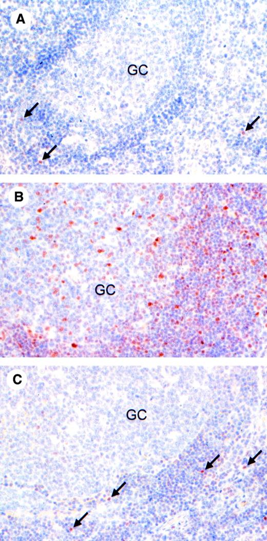 Fig. 2. Expression of phosphorylated STAT proteins in normal lymphoid tissue. / Expression of P-STAT6 (A), P-STAT3 (B), and P-STAT5 (C) was examined by immunohistochemistry in formalin-fixed sections of a reactive human tonsil. P-STAT6 and P-STAT5 demonstrated low basal levels of expression, with rare nuclear staining of lymphocytes (arrows) outside of the germinal center (GC). Basal levels of P-STAT3 were significantly higher, with numerous positive cells within and outside of the GC. Original magnifications, × 500.
