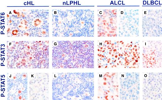 Fig. 3. Expression of phosphorylated STAT proteins in malignant lymphomas. / Expression of P-STAT6 (A-E), P-STAT3 (F-I), and P-STAT5 (J-O) was examined by immunohistochemistry in formalin-fixed sections of classical HL (cHL), nLPHL, ALCL, and DLBCL. Staining for nuclear P-STAT6 was positive in HRS cells of cHL (A). In nLPHL, lymphocytic and histiocytic cells were P-STAT6−, whereas scattered macrophage nuclei were P-STAT6+ (B). P-STAT6 was also positive in 33% cases of ALCL (C-D), and negative in DLBCL (E). Nuclear P-STAT3 was present in HRS cells and cells in the reactive infiltrate in cHL (F), lymphocytic and histiocytic cells and cells in the reactive infiltrate from nLPHL (G), ALCL (H), and DLBCL (I). Nuclear P-STAT5 was present in HRS cells in 26% of cHL (J-K), negative in lymphocytic and histiocytic cells in nLPHL (L), positive in 50% of ALCL (M-N), and negative in DLBCL (O). Original magnifications, × 720.