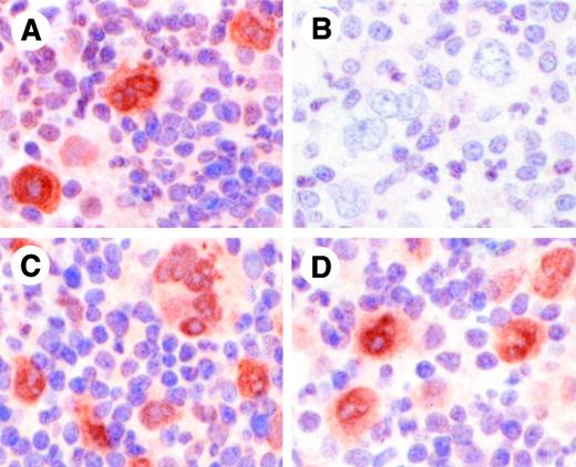 Fig. 4. Specificity of antiphospho-STAT6 antibody for phospho-STAT6. / Antiphospho-STAT6 antibody was preincubated for 1 hour without peptide (A), with phospho-STAT6 peptide against which the antibody was raised (B), phospho-STAT3 peptide (C), or phospho-STAT5 peptide (D), prior to immunohistochemical staining of a case of classical HL. HRS cells demonstrate positive staining with antibody alone (A), which is completely abrogated by preincubation with the phospho-STAT6 peptide (B). Preincubation of antiphospho-STAT6 antibody with phospho-STAT3 (C) or phospho-STAT5 (D) peptides did not affect staining. Original magnifications, × 1340.