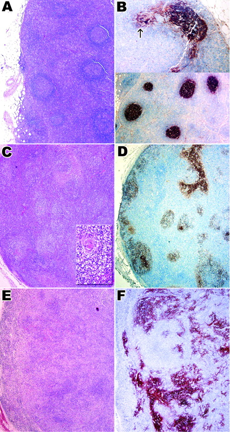 Fig. 1. Histologic features and CD21 expression in 3 histologic patterns of AITL. / Panels A and B show case 2 with histologic pattern I, panels C and D show case 10 with histologic pattern II, and panels E and F show case 28 with histologic pattern III. (A,C,E) Hematoxylin and eosin–stained sections showing 3 different histologic patterns. Inset in panel C highlights a depleted follicle. Follicular architecture is retained in pattern I (A) and II (C) but is completely lost in pattern III (E). (B,D,F) Immunostaining for CD21 in 3 histologic patterns. There is only focal proliferation of FDCs in pattern I (B, upper panel; arrow); in patterns II and III (panels D and F), there is increasing FDC proliferation. Original magnification A-F, × 40; C inset, × 200.