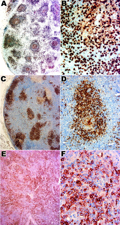 Fig. 2. CD10 expression in the 3 histologic patterns of AITL. / Panels A and B show case 2 with histologic pattern I, panels C and D show case 10 with histologic pattern II, and panels E and F show case 28 with histologic pattern III. Numerous medium-sized lymphoid cells in and around the follicles in pattern I (A,B) and II (C,D) are CD10+. Panel B shows that the intensity of staining is much higher in these cells compared with weakly staining follicle center B cells. The follicular distribution is lost in pattern III (E) in which a diffuse infiltrate of CD10+ cells is seen. Panel F shows that some of these are large atypical lymphoid cells. Original magnification A, C, E, × 40; B, F, × 400; D, × 200.