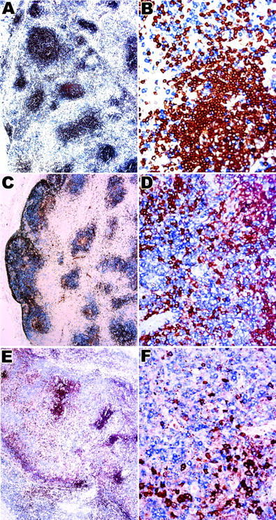 Fig. 3. CD20/CD10 double immunostaining in the 3 histologic patterns of AITL. / Panels A and B show case 2 with histologic pattern I, panels C and D show case 10 with histologic pattern II, and panels E and F show case 28 with histologic pattern III. (A-F) Double immunostaining for CD20 in brown (DAB) and CD10 in blue (fast blue). Numerous single blue cells expressing CD10 but not CD20 are seen around the follicles and in the paracortical areas. Panels B, D, and F show high-power view of double immunostaining for CD20 and CD10. Original magnification A, C, E, × 40; B, D, F, × 400.