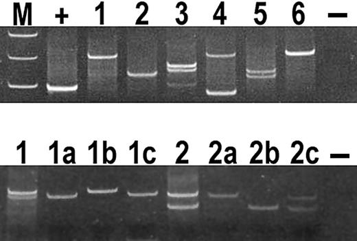 Fig. 4. Analysis of PCR products for TCR-γ chain gene on polyacrylamide gels in AITL. / (Top panel) All cases demonstrated in the figure show 1 or 2 dominant bands consistent with a monoclonal T-cell population. Lane M, molecular weight markers; lane +, positive control; lane 1, case 21; lane 2, case 23; lane 3, case 26; lane 4, case 22; lane 5, case 3; lane 6, case 4; and lane −, negative control. (Bottom panel) Microdissection of CD10+ cells in cases 26 and 13 gave PCR products identical in size to products obtained from whole-section PCR. Lane 1, whole-section PCR products of case 26; lanes 1a,b,c, microdissected PCR products of case 26; lane 2, whole section PCR products of case 13; lanes 2a,b,c, microdissected PCR products of case 13; and lane −, negative control.