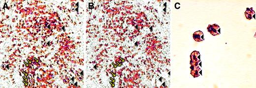 Fig. 5. Microdissection of CD10+ cells in AITL. / (A) CD10 stained section before microdissection; the cells targeted for microdissection are indicated with arrows and arrowheads. (B) Same area after microdissection; the arrows and arrowheads indicate spaces left after cells have been removed. (C) High-power view of a cluster of CD10+ cells after microdissection. These are the cells/spaces indicated by arrows in the panels A and B. Original magnification A, B, × 200; C × 400.
