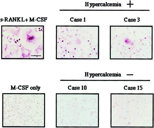 Fig. 3. Morphology of OCLs induced by coculture of HPCs with ATL cells. / Giant multinucleated cells were observed when HPCs were cocultured with ATL cells from patients with hypercalcemia (cases 1 and 3). In contrast, such OCLs were not observed when HPCs were cocultured with ATL cells from patients without hypercalcemia (cases 10 and 15).