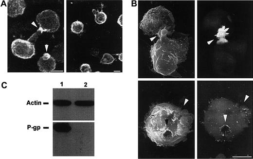 Fig. 8. Effects of antisense PONs on P-gp localization and actin association on CEM-VBL100 cells. / (A) Immunofluorescence analysis of P-gp cellular distribution in ERM sense (left panel) and antisense (right panel) PON-treated CEM-VBL100 cells. Arrows (left panel) point to the polarized distribution of P-gp in sense PON–treated cells; in contrast, antisense PON–treated cells (right panel) did not show any feature of polarization, together with an altered P-gp distribution on the cell surface. Bar = 5 μm. (B) Immuno-SEM analysis of P-gp distribution in ERM sense (upper panels) and antisense (lower panels) PON-treated CEM-VBL100 cells. The polarized morphology of sense PON–treated CEM-VBL100 cells (arrows, upper left panel) was completely lost after antisense PON treatment (arrows, lower left panel). Consistently, P-gp distribution, highly polarized on uropoidal formations (arrows, upper right panel), was clearly altered and unpolarized in antisense PON–treated cells (arrows, lower right panel). No appreciable labeling was detected in control conjugate samples incubated with irrelevant mAb. Bar = 5 μm. In both (A) and (B), 1 of 5 representative experiments is shown. (C) Coimmunoprecipitation analysis of CEM-VBL100 cells pretreated with sense (1) or antisense (2) ERM PONs. Actin immunoprecipitates were separated by SDS-PAGE in nonreducing (upper panel) or reducing (lower panel) conditions (see “Materials and methods”) and blotted with anti-actin or anti–P-gp mAb, respectively.